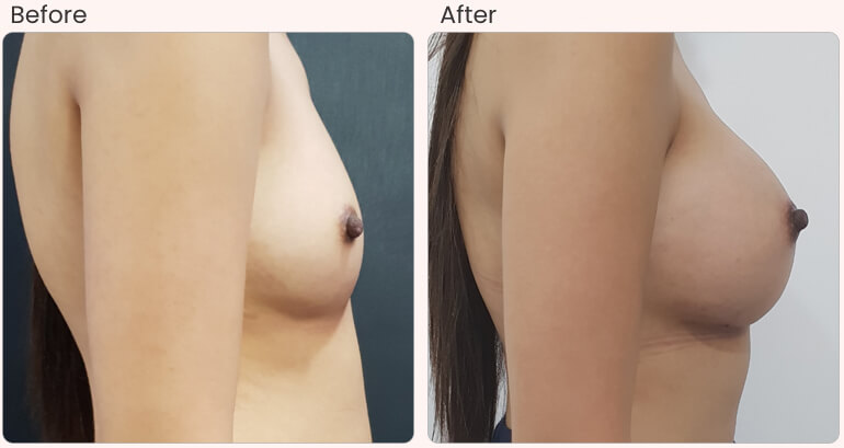 botox filler treatments