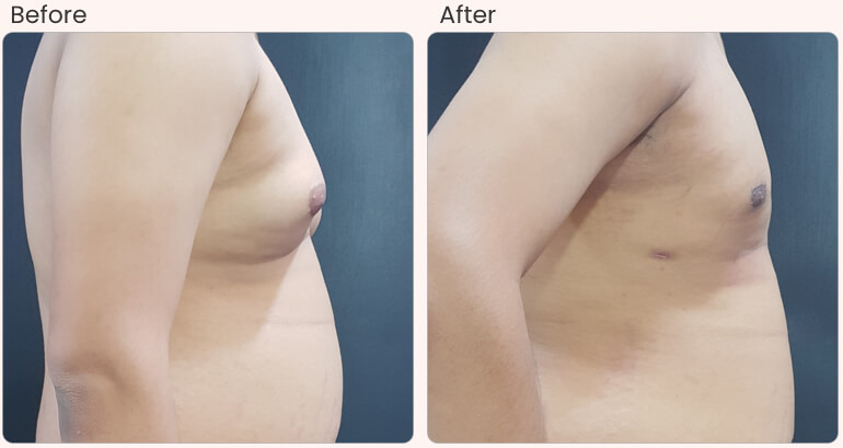 botox filler treatments
