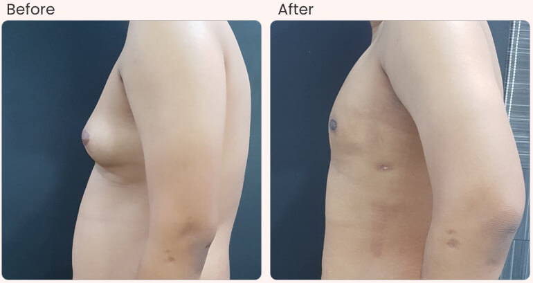 botox filler treatments