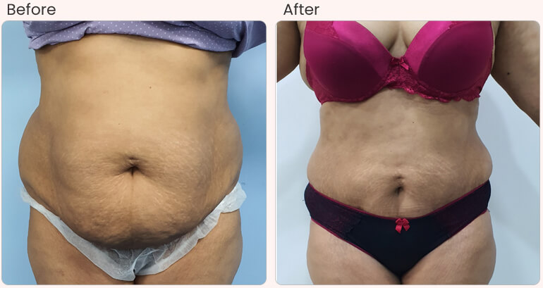 botox filler treatments