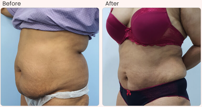 botox filler treatments