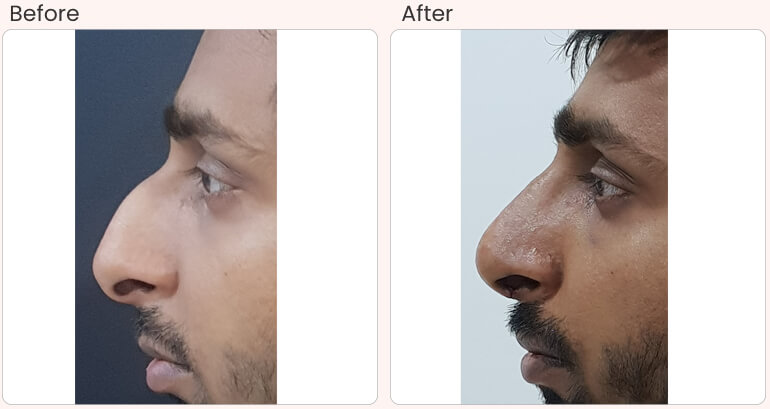 botox filler treatments